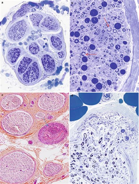 Examination of the Peripheral Nerve Biopsy | Neupsy Key