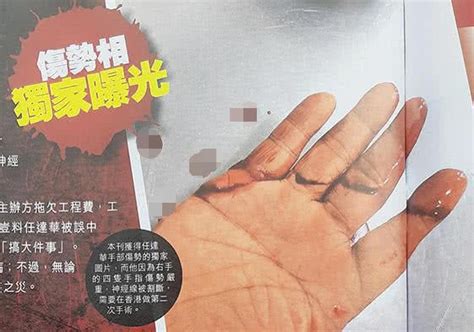 任达华右手伤口曝光！四只手指被割伤 神经被割断 搜狐大视野 搜狐新闻