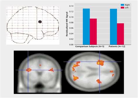 Lateral Prefrontal Cortex Activation After Exposure To Negative