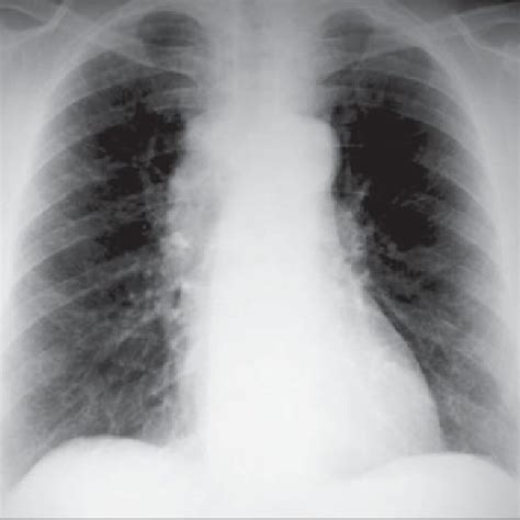 Postero Anterior Chest Radiography Showing Superior Mediastinal