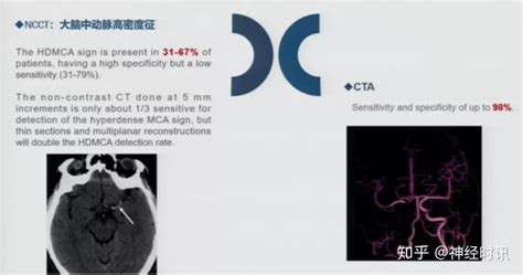 急性缺血性脑卒中的影像学评估 知乎