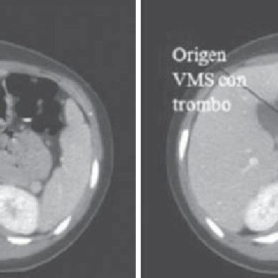 Tomograf A Computarizada Abdominal Que Muestra La Presencia De Un