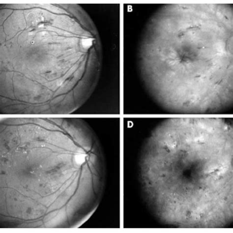 Color fundus photograph of left fundus 2 weeks after the application of ...