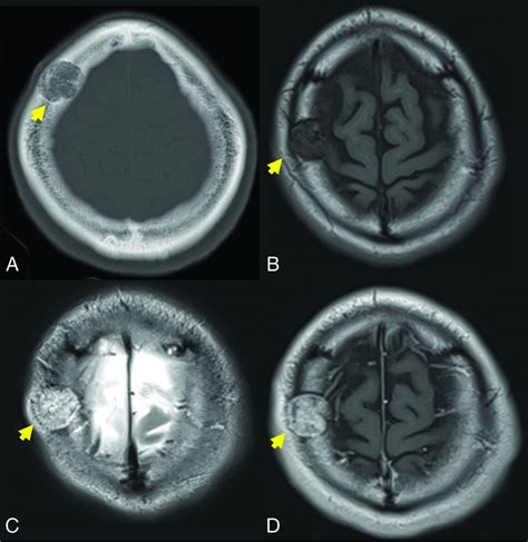 Intraosseous Venous Malformations Of The Head And Neck American Journal Of Neuroradiology