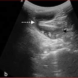 A Longitudinal Sonogram Of Left Popliteal Fossa Demonstrates Cystic