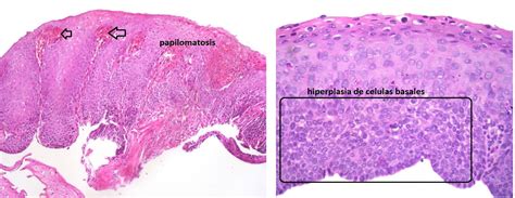 Gastrointestinal And Liver Histology Pathology Atlas Esophagus Gastroesophageal Reflux Gerd