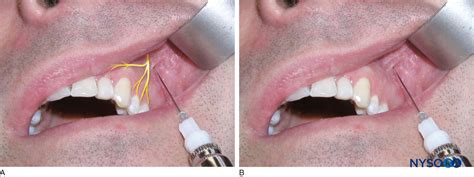 Mucobuccal Fold