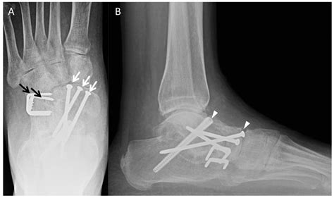 Diagnostics Free Full Text Postoperative Findings Of Common Foot