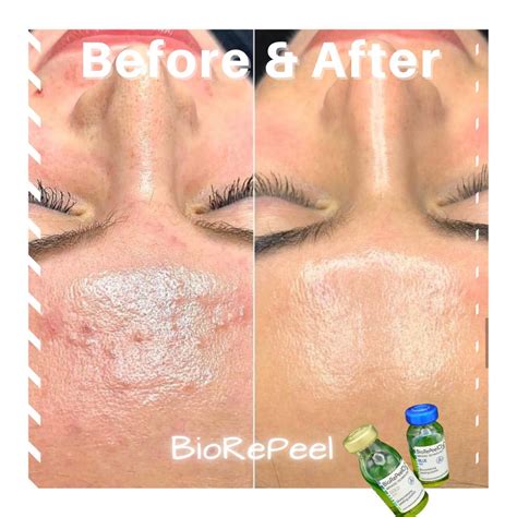 BioRePeelCl3® Treatments | Face Glow Skincare & Laser