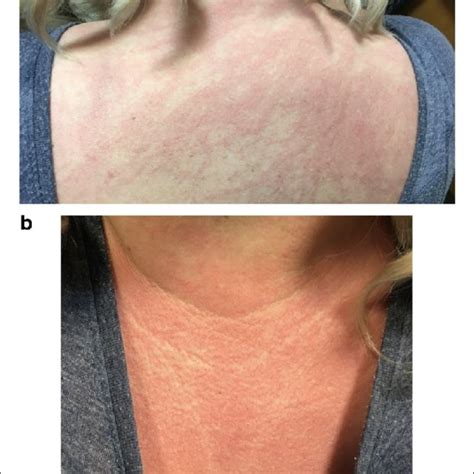 Clinical Features Of Dermatomyositis Including Facial Heliotrope Rash