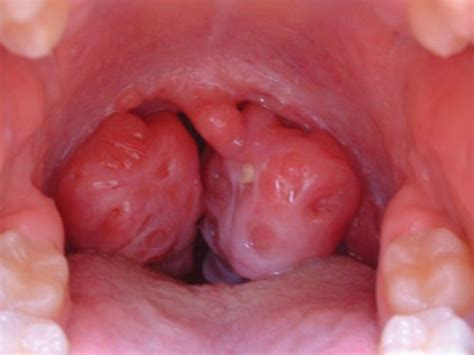 Cirugía de Amígdalas y Adenoides Otorrinolaringologia