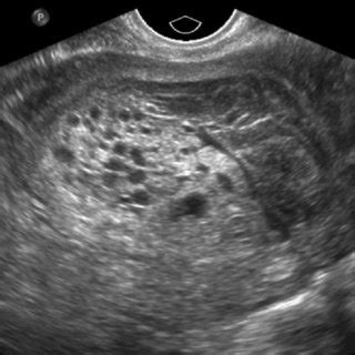 Transvaginal Ultrasound Of The Uterus Note The Uterine Fundus F Images