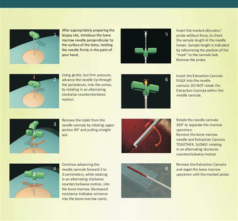 Bone Marrow Biopsy Needle System Trephine Disposablebox Of 5