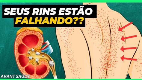 Sinais De Alerta 10 Sintomas Que Indicam Problemas Nos Rins YouTube