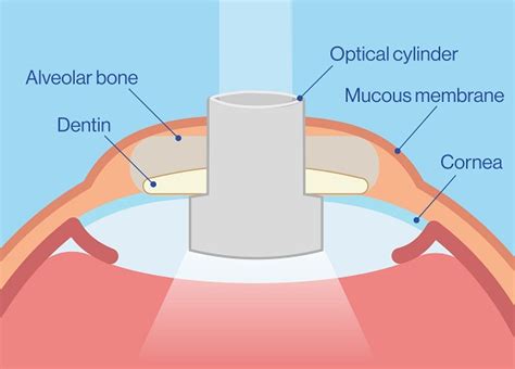 Keratoprosthesis What Is It Oftalvist