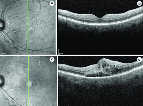 Optical Coherence Tomography Oct Images Of The Left Eye At And