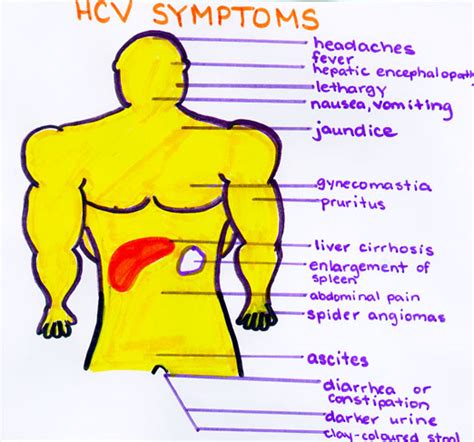 Hepatitis C Symptoms: The lethal 'C'