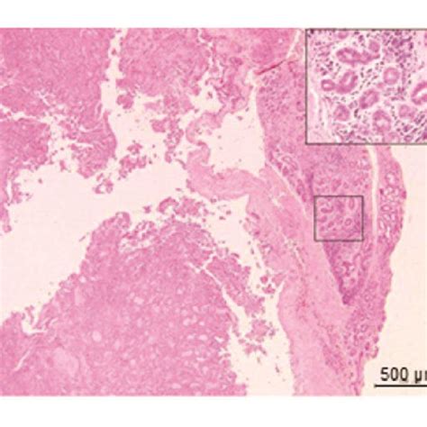 Histopathological Features Of Sc The Excised Tissue With Areas Of