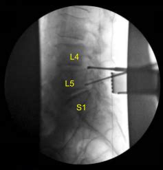 Case Study L And L Laminectomy With Neurolysis Complete