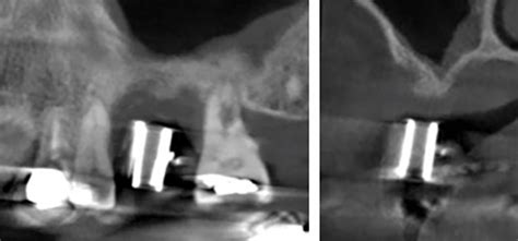 simplified  predictable approach  crestal sinus elevation