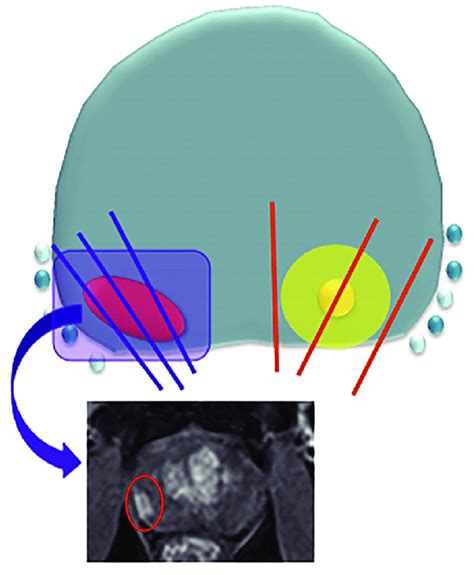 Illustration Of Targeted And Systematic Biopsy Cores In Relation To Download Scientific Diagram