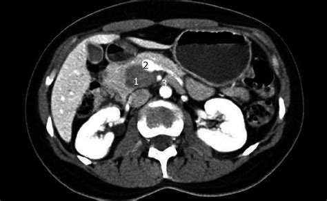 Uncinate Process Of Pancreas Anatomy