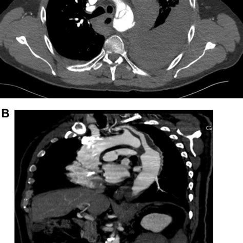 A Ct Scan Showing An Aortic Dissection And Aortic Rupture B Ct Scan