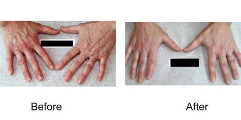 Premium Hand Vein Treatments Madison Medispa Waunakee