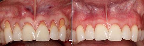 Periodontal Procedure Before And After Photos In Los Angeles