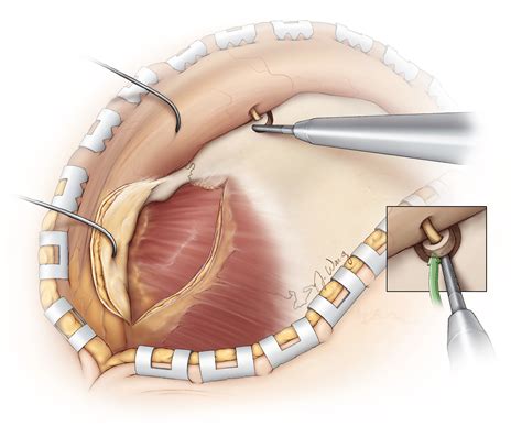 Orbitozygomatic Craniotomy The Neurosurgical Atlas