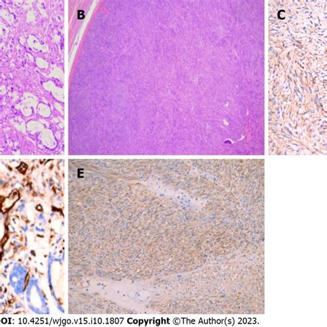 Pathological And Immunohistochemical Features Of Gastric Cancer Download Scientific Diagram