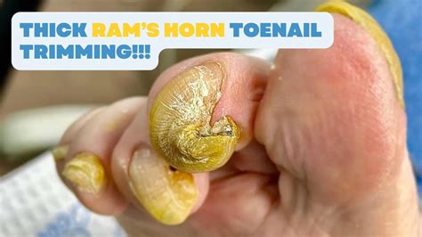 Thick RAMS HORN TOENAIL Trimming YouTube