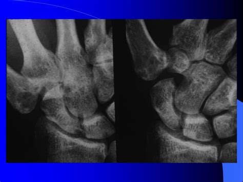 Excision Of The Trapezium Presentation