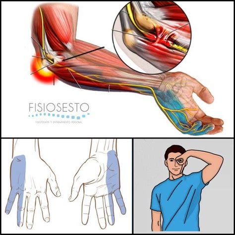 Exclusi N Falta Base Dolor Cubital Mu Eca Tratamiento Paso Peatonal