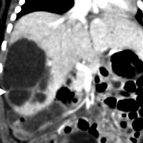 Computed Tomography Ct Scans Of The Abdomen Ct Scans Showed A