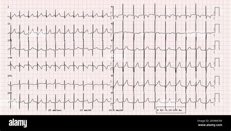 Esempio Di ECG Di Un Normale Ritmo Sinusale A 12 Derivazioni Pediatrico