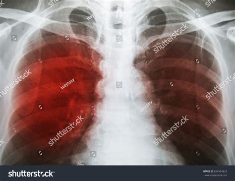 Pulmonary Tuberculosis Tb Chest Xray Show Stock Photo 624934823