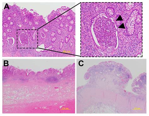 Ijms Free Full Text P53 Expression As A Diagnostic Biomarker In Ulcerative Colitis