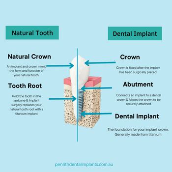 Dental Implants Benefits Risk Procedure Cost