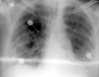 Acute Respiratory Distress Syndrome ARDS Imaging Practice Essentials