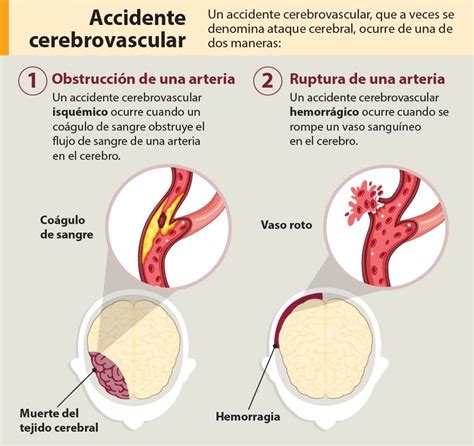 Acerca Del Accidente Cerebrovascular