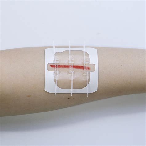 Elastic Pu Film Zip Tie Wound Closure Device For Emergency Wound