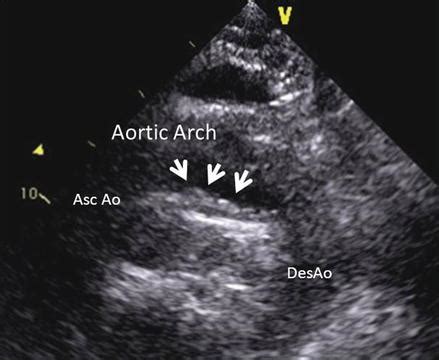 Atherosclerosis Of Aorta Ultrasound