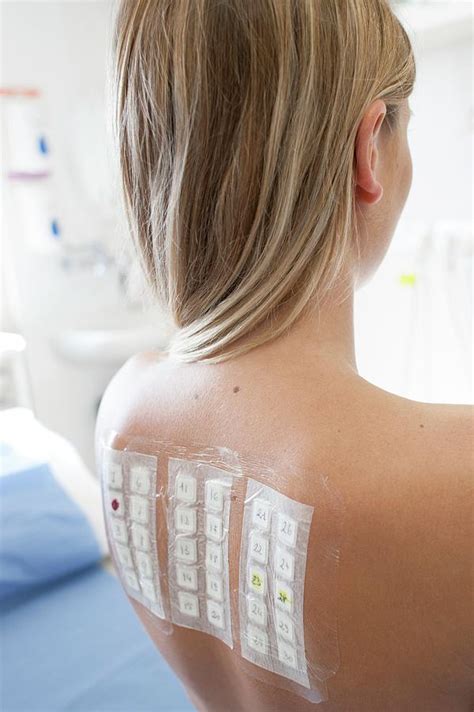 Patient Undergoing A Patch Test In Allergy Clinic Photograph By Science