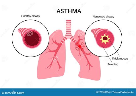 Asthma Lung Disease Stock Vector Illustration Of Lung 273188354