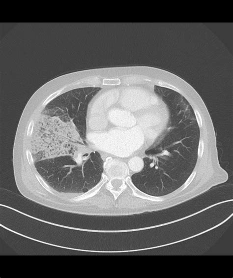 Pulmonary Infarction Radiology Reference Article