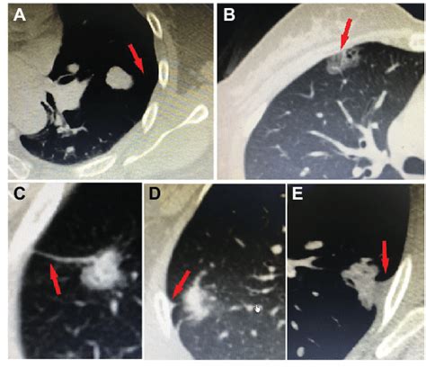 Figure S1 Five Types Of Tumor Pleural Surface Relationship Notes A