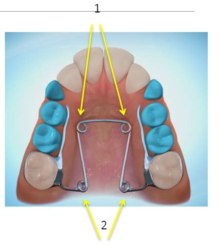 Ortho Exam 3 All Flashcards Quizlet