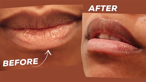 How Long Does It Take For Lips To Heal After Biting Lip Lipstutorial Org