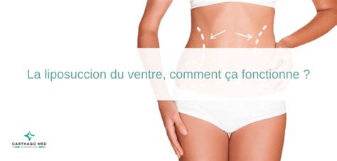 Liposuccion Du Ventre Fonctionnement Avantages Et Processus